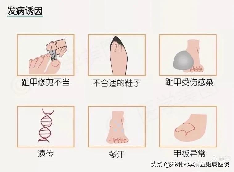 小孩怎么预防嵌甲,怎么预防嵌甲和甲沟炎