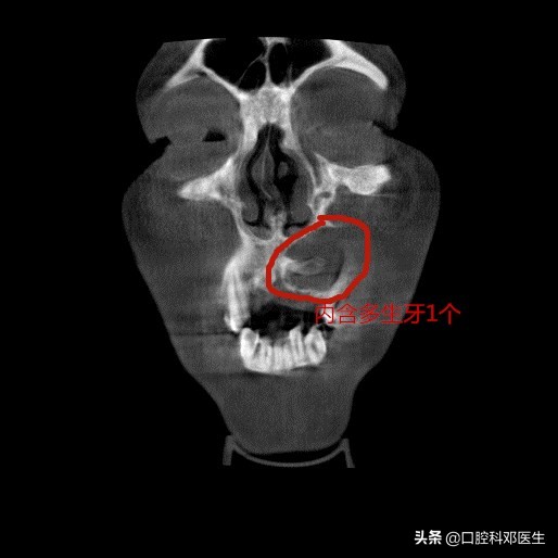 上颌埋伏阻生牙拔除多久能矫正,水平阻生埋伏牙真实拔除过程