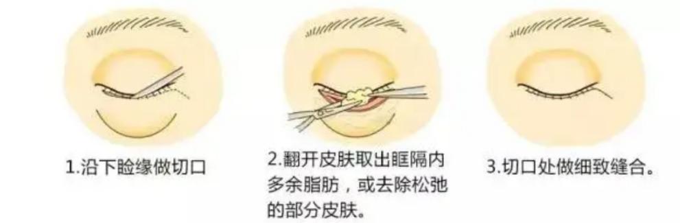 涂眼霜可以祛眼袋？不现实！祛眼袋的三种靠谱方法看这里