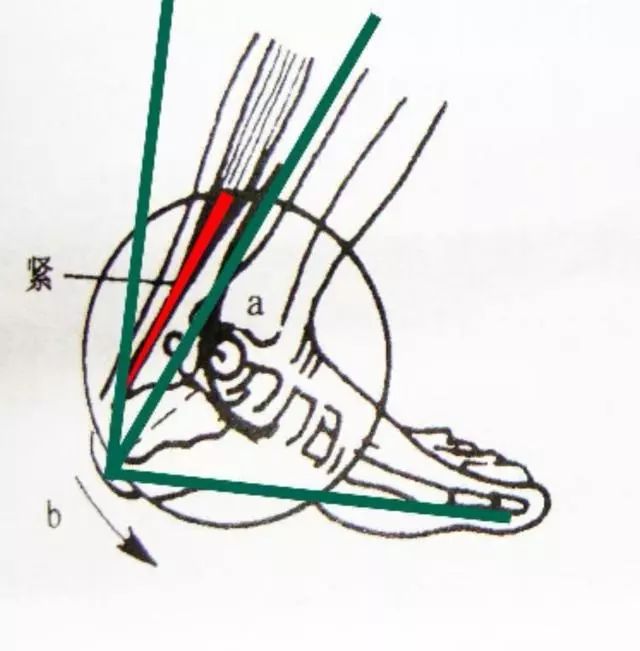 跟腱断裂和前叉损伤,前叉断裂和跟腱断裂哪个严重