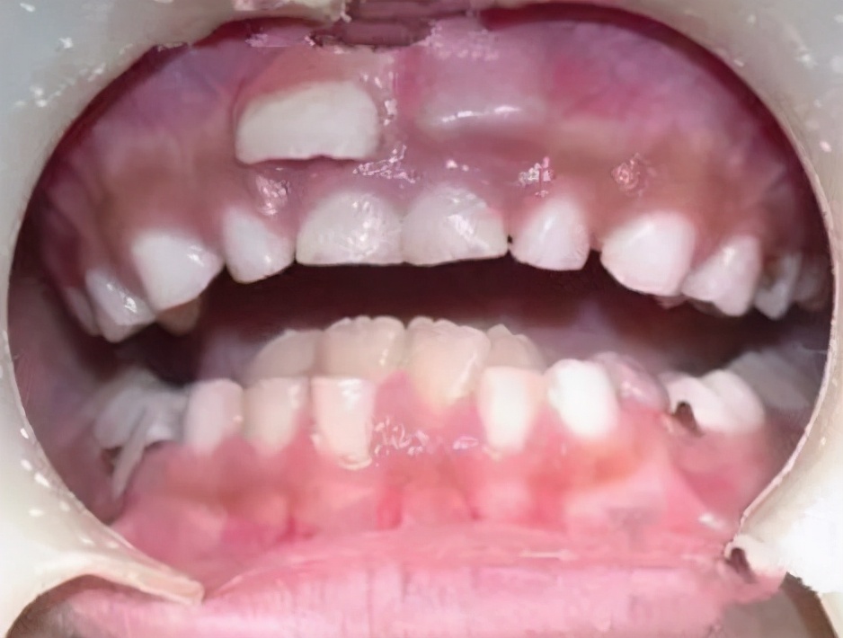 为什么乳牙好换牙就不好了,为什么现在的孩子换的门牙特别大