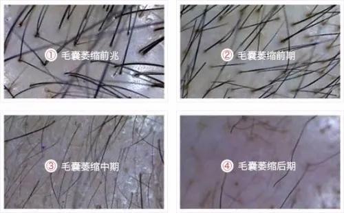 毛囊萎缩的症状有哪些,毛囊萎缩和休止期有什么区别