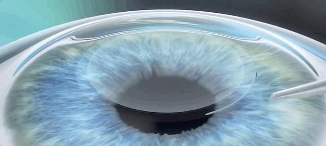 激光近视矫正手术有什么后遗症,激光矫正近视和散光有什么后遗症