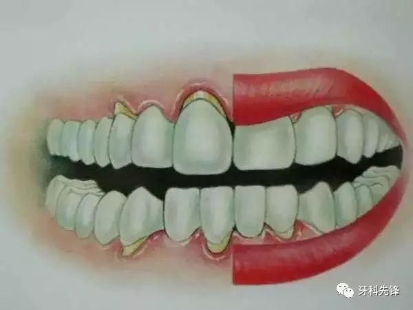 牙缝漏风很少塞牙,牙缝大吃饭塞牙吃什么好