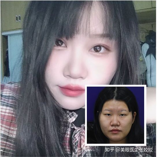 胖妹妹适合割双眼皮吗,胖女孩割双眼皮