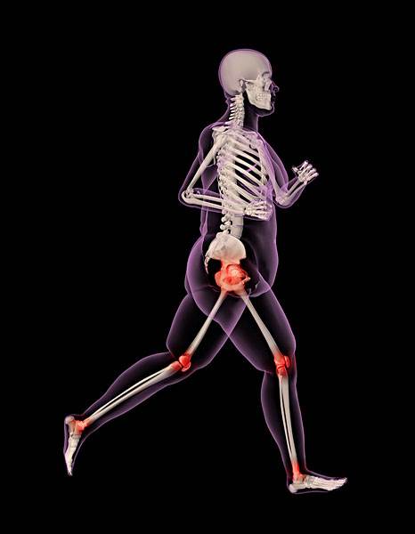 肥胖也会诱发骨性关节炎,肥胖是不是会导致膝盖疼