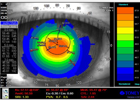 圆锥角膜一般度数是多少,圆锥角膜几岁能查出来