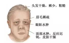 甲减的主要症状有哪些,孕期甲减症状表现有哪些