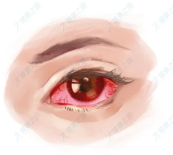 眼白变黄会癌变吗,眼白充血要警惕四种疾病