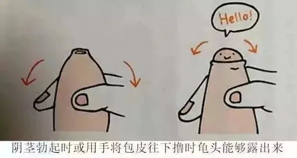 割包皮的几个棘手的情况,医院割包皮会不会被宰