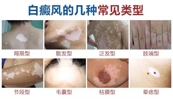 别人白斑很快恢复，自己却治疗很久也不见效果，这是怎么回事？