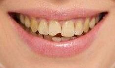 小孩口臭长出的新牙也黄,口臭牙黄怎么办学生党