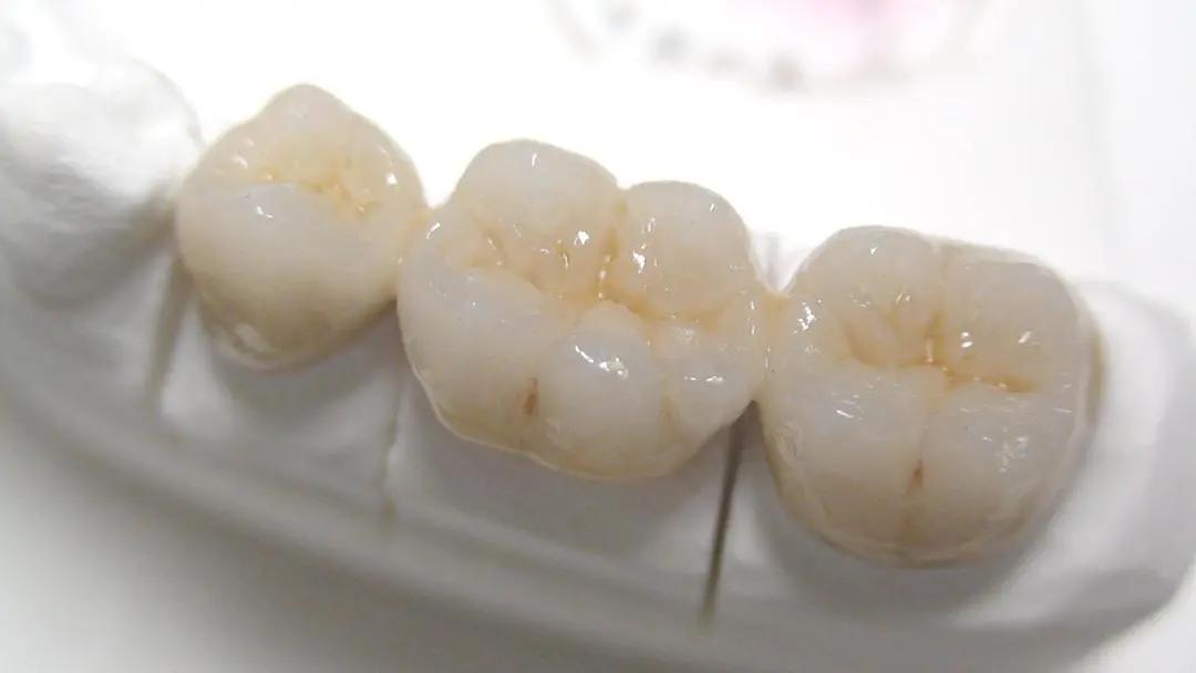 烤瓷牙和全瓷牙优缺点比较,烤瓷牙与全瓷牙的区别和优缺点