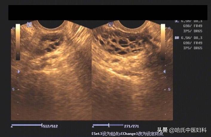 多囊卵巢综合症引起闭经怎么治疗,多囊卵巢综合症闭经了怎么办