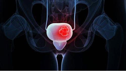 膀胱癌用药一览表,膀胱癌临床适应对患者的影响