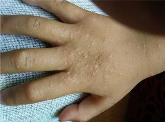 带孩子去海边需要注意什么,孩子去海边玩身上起红疹子