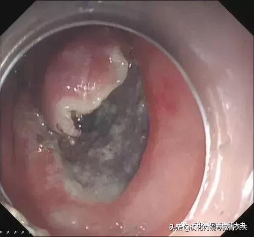 通过科普文章求治的一例胃窦后壁早癌