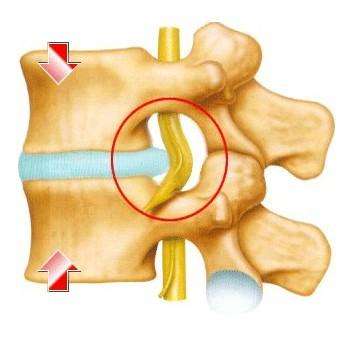 肩膀颈椎疼痛手臂发麻怎么缓解,颈椎病压迫手臂麻木吃什么药
