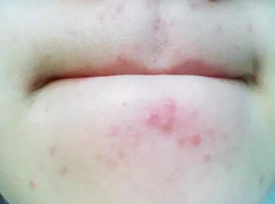 下巴反复长痘痘的原因和解决方法,下巴老是长痘痘怎么调理身体啊