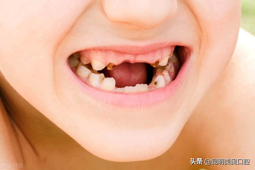 牙齿美白误区有哪些,美白牙齿的误区都有哪些