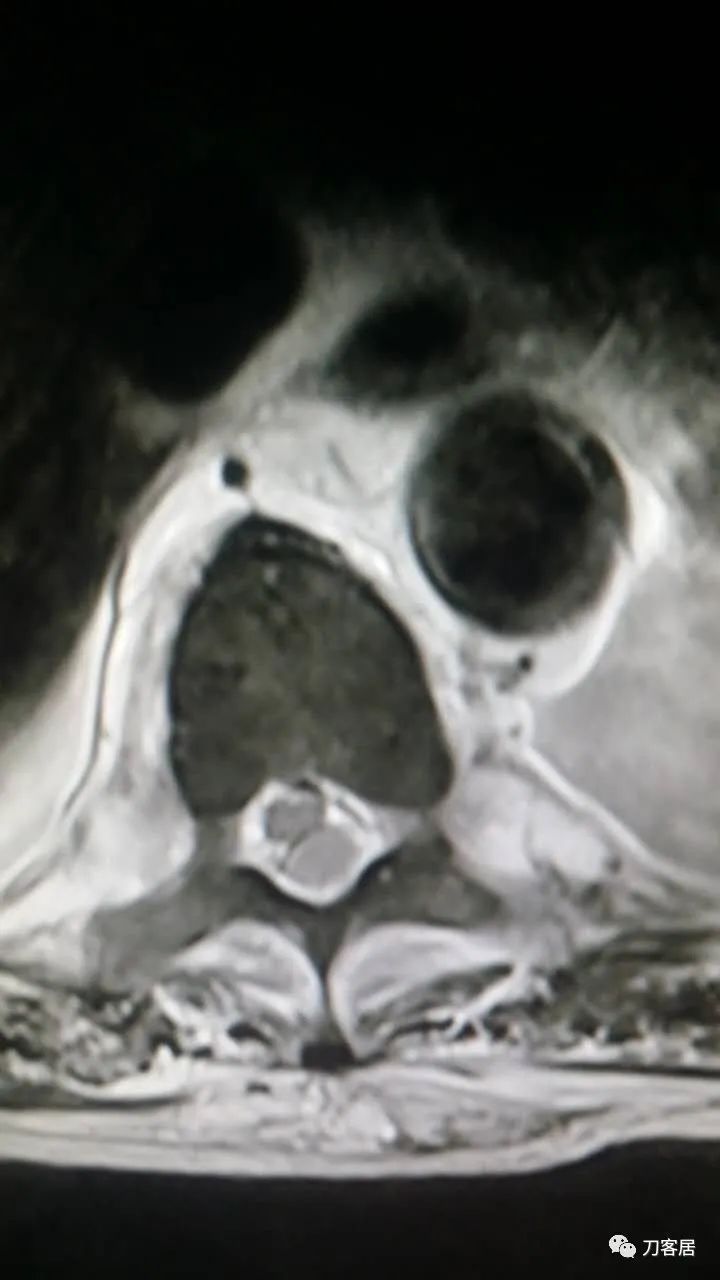 腰椎手术切掉棘突,腰突微创后出血肿