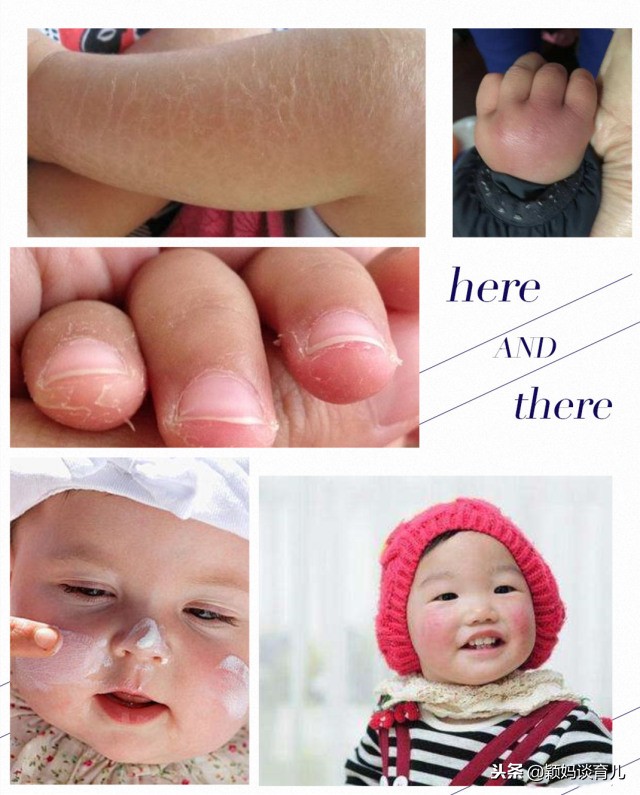 一到冬天皮肤干燥起皮用什么护肤,一到换季宝宝皮肤干燥