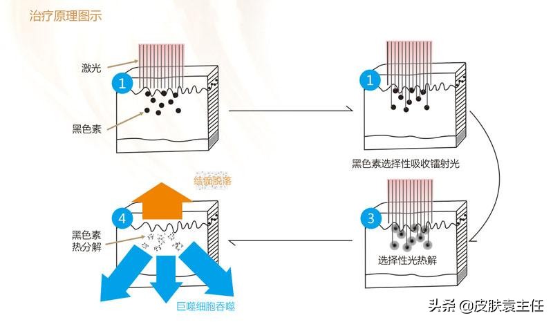 遮瑕遮不住雀斑怎么办,什么样的遮瑕可以遮掉雀斑