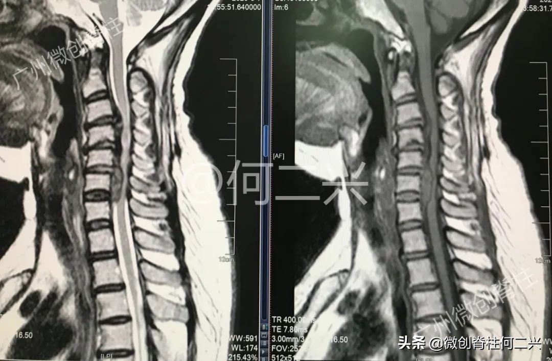 脊柱外科微创手术全过程,胸椎后纵韧带骨化症微创手术