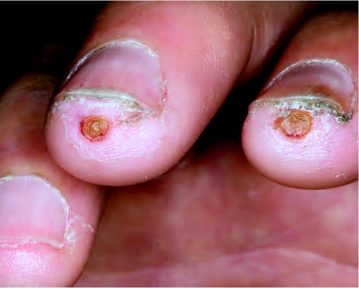 多发性硬化症和系统性硬皮病,系统性硬皮病有什么症状