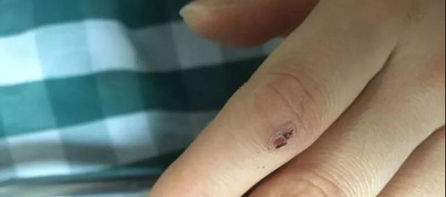 贵州被毒蛇咬了去哪个医院,野外银环蛇咬伤事件