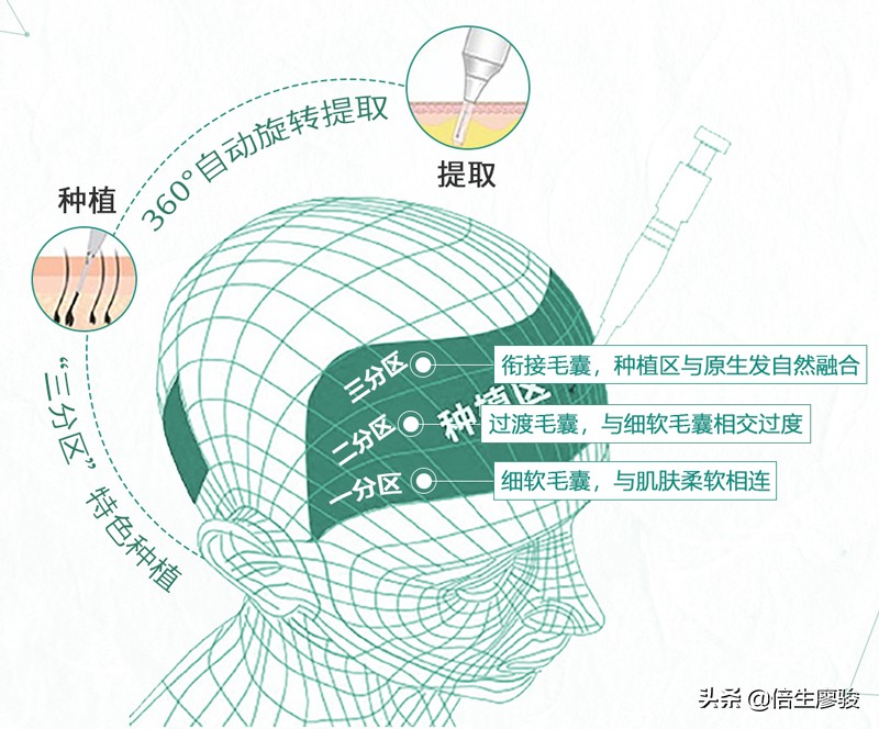 植发对额头的修饰,植发改善秃子