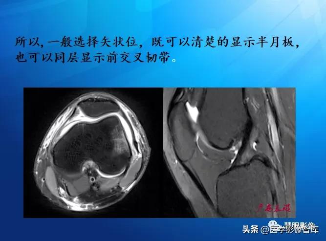 膝关节半月板损伤的解剖结构图,半月板mri解剖图解