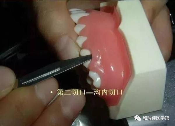 松牙固定需要什么条件,钢丝松牙固定操作流程