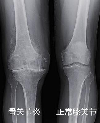 腿疼膝盖骨刺的最快解决方法,膝盖骨刺关节炎疼痛解决最好办法