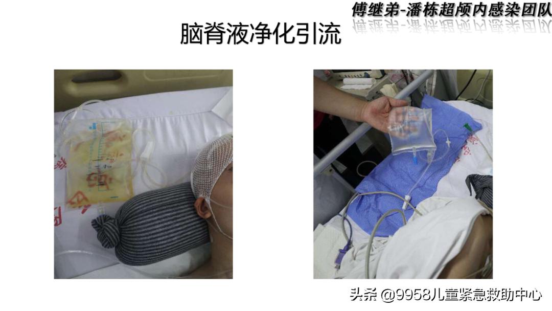 颅内感染康复治疗知识,小儿颅内感染的健康宣教