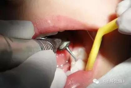 医生蛀牙没补干净怎么办,蛀牙小洞医生不建议补