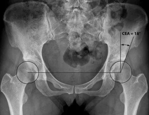 髋关节发育不良的正确诊断与治疗,髋关节发育不良和正常的区别