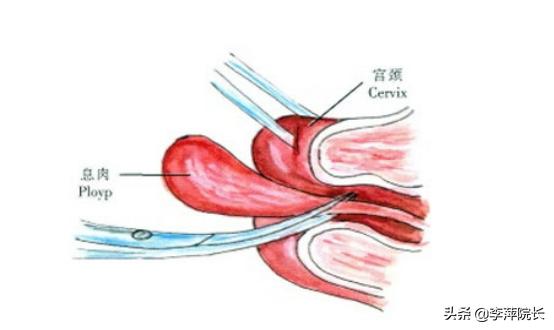 子宫颈息肉能影响怀孕吗