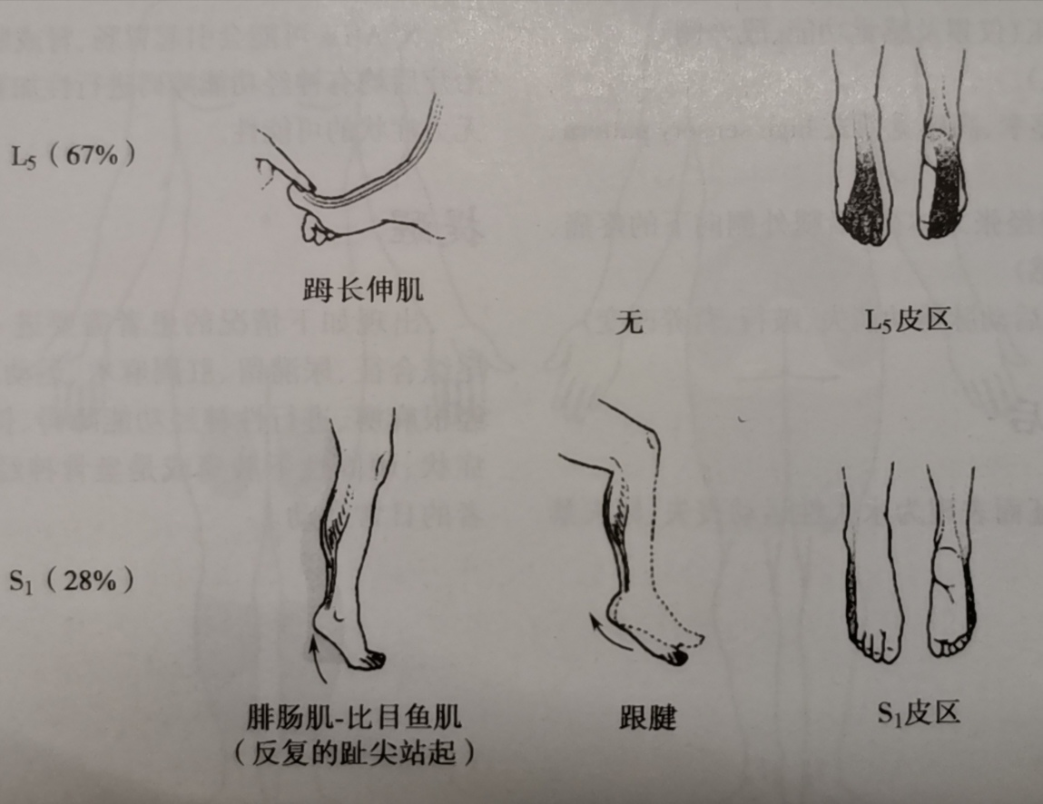 出现下肢麻木、运动无力，就是腰间盘突出症？医生：那可不一定