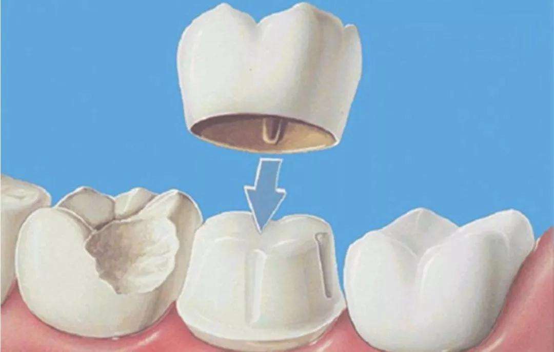 美白牙齿方法洗牙,除了洗牙怎么美白牙齿