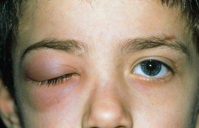 急性眼疾要注意什么,各种眼疾的症状