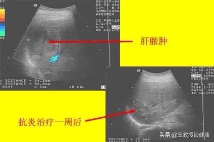 脓肿为什么会有硬结,肝脓肿和糖尿病的关系