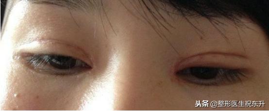 割双眼皮后怎样可以尽快完全恢复,割的双眼皮很不自然要怎么修复呢