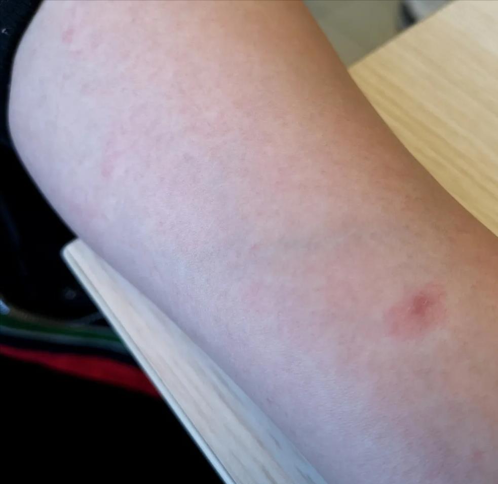 怀孕期间肚皮痒有红斑是怎么回事,孕晚期妊娠瘙痒性丘疹怎么治疗