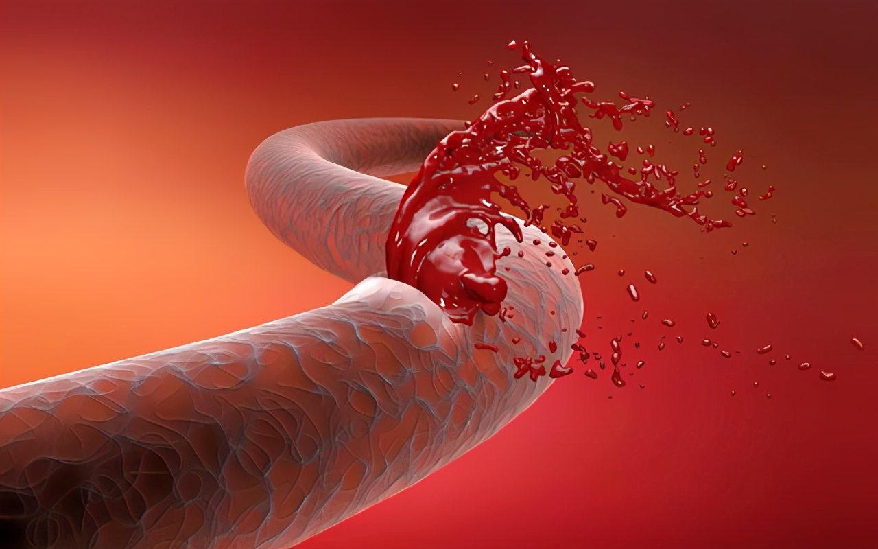 过敏性紫癜夏天血管变脆吗,血管紫癜是什么原因引起的