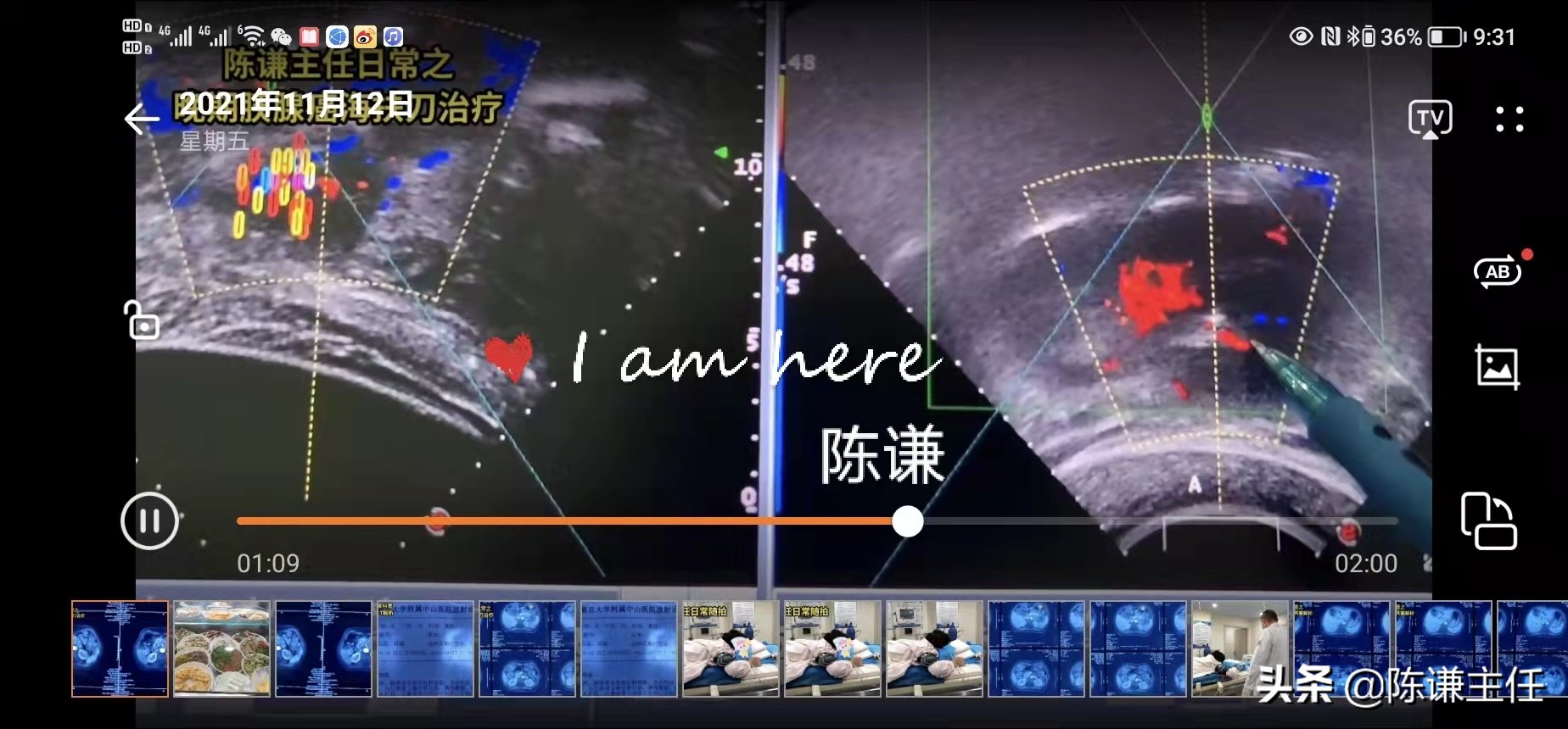 81岁胰腺癌海扶刀治疗后肿瘤消失,77岁胰腺癌是否适合手术