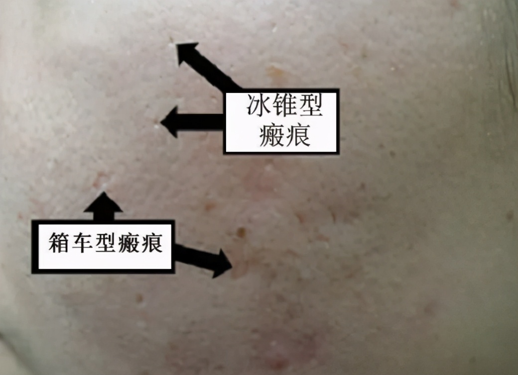 脸上长疮后留下疤痕怎么去除,疮疤怎么彻底消除