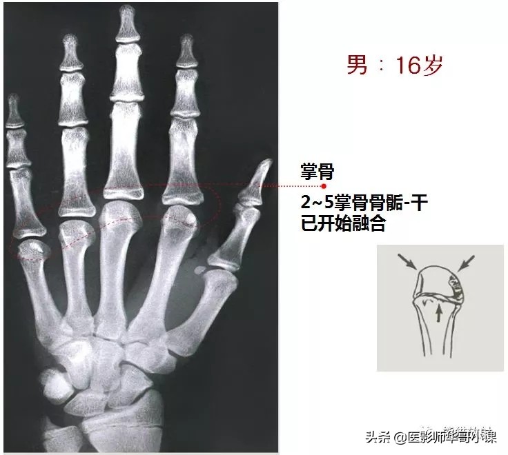骨龄片对照图谱测骨龄准不,骨龄14岁男孩骨龄图谱