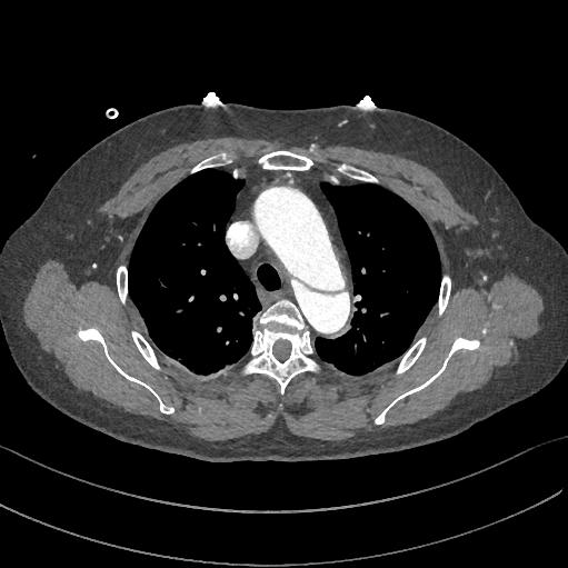 如何监测动脉夹层早期,动脉增强ct能查出主动脉夹层么