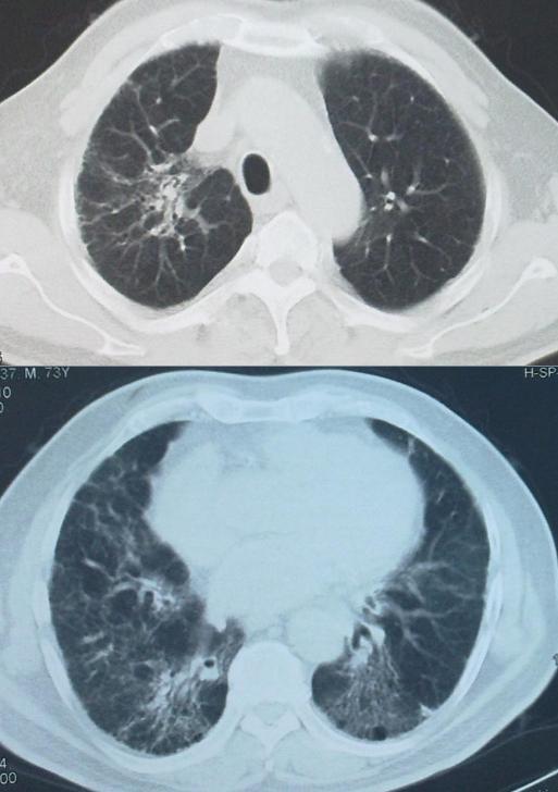 养鸽子造成皮肤真菌感染,养鸽子会得肺炎吗